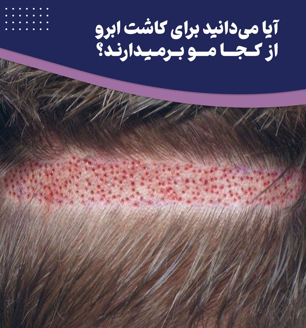 محل برداشت مو برای کاشت ابرو کجاست