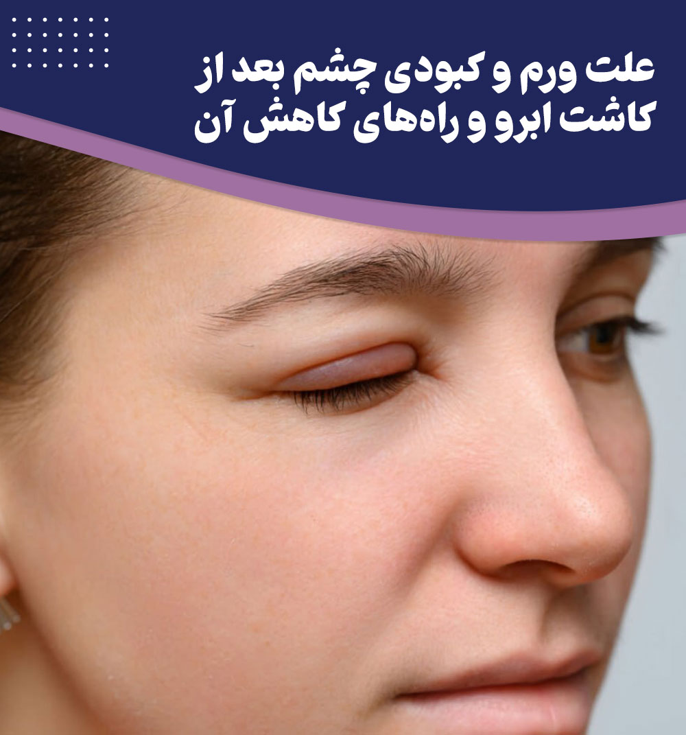 بعد از کاشت ابرو چه کنیم تا ورم و کبودی چشم زودتر از بین برود