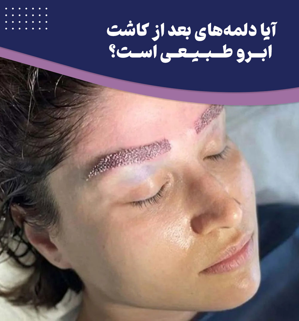 چگونه دلمه بعد از کاشت ابرو را درمان کنیم