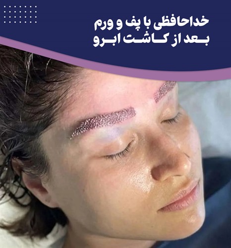 راهکارهایی ساده و کاربردی برای کاهش ورم بعد از کاشت ابرو