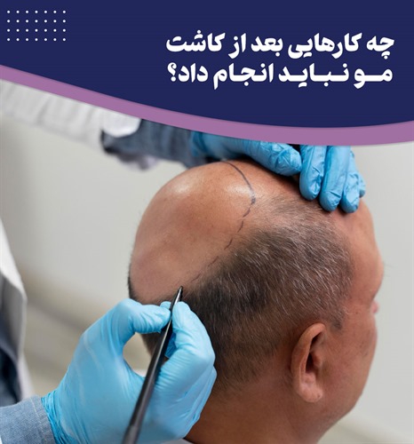 16 کار ممنوع بعد از کاشت مو