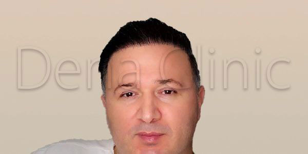 نمونه کار کاشت مو