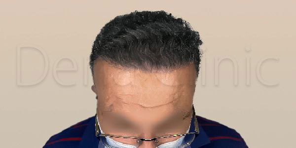 نمونه کار کاشت مو
