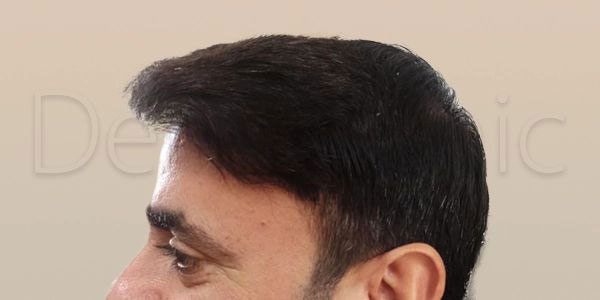 نمونه کار کاشت مو