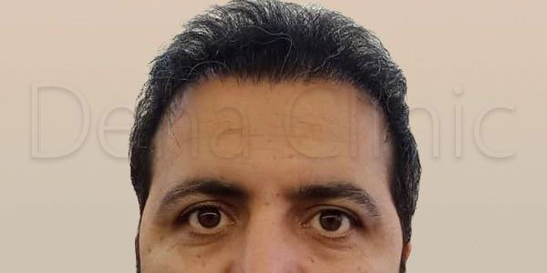 نمونه کار کاشت مو
