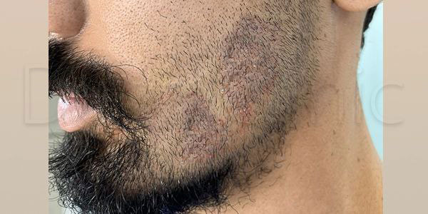 نمونه کار کاشت ریش و سبیل
