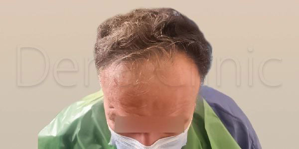 نمونه کار کاشت مو