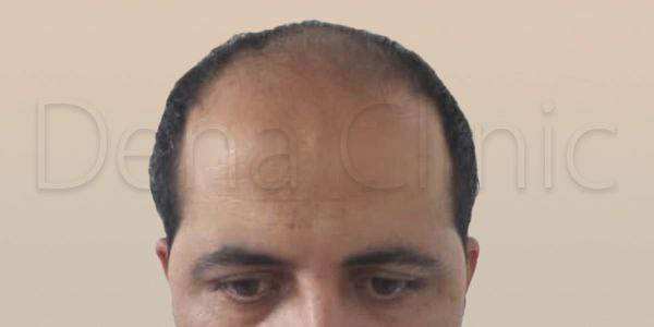 نمونه کار کاشت مو