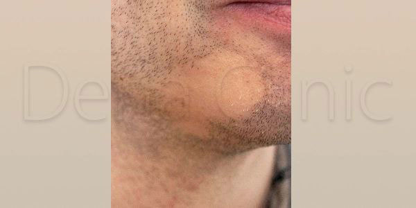 نمونه کار کاشت ریش و سبیل