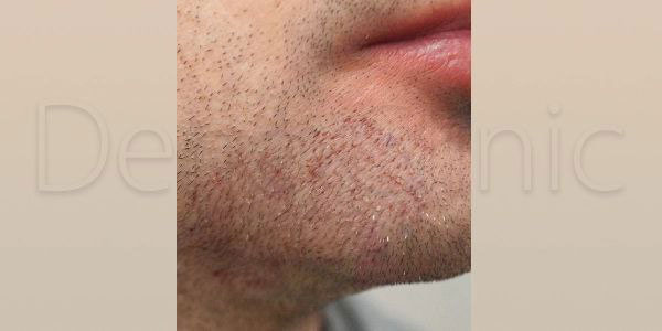 نمونه کار کاشت ریش و سبیل