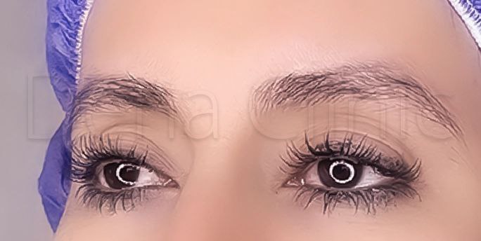 نمونه کار کاشت ابرو