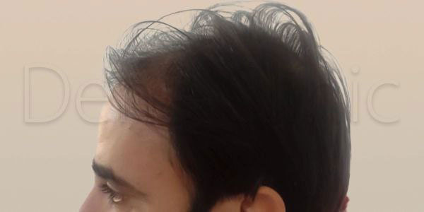 نمونه کار کاشت مو