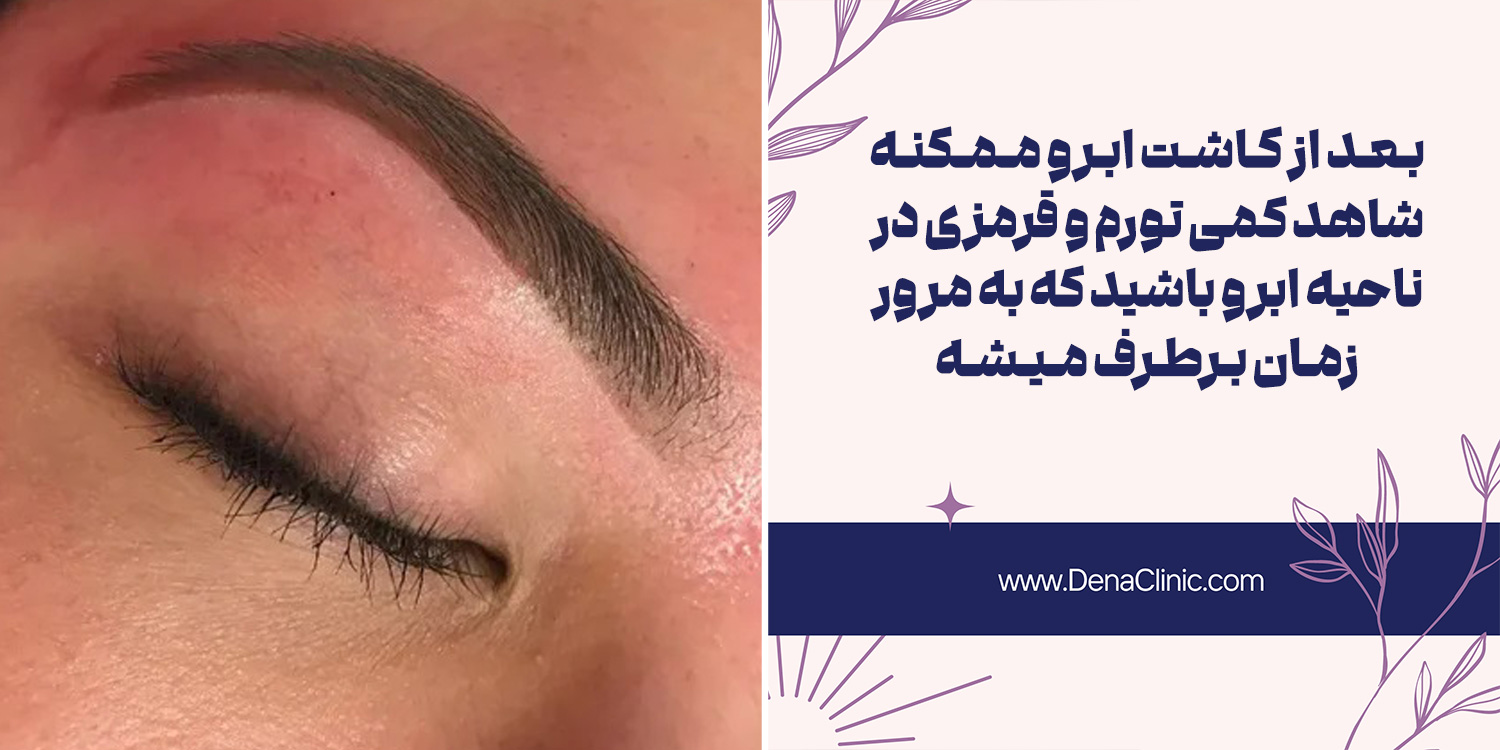 دوره نقاهت و مشاهده نتیجه یکی از مراحل کاشت ابرو طبیعی
