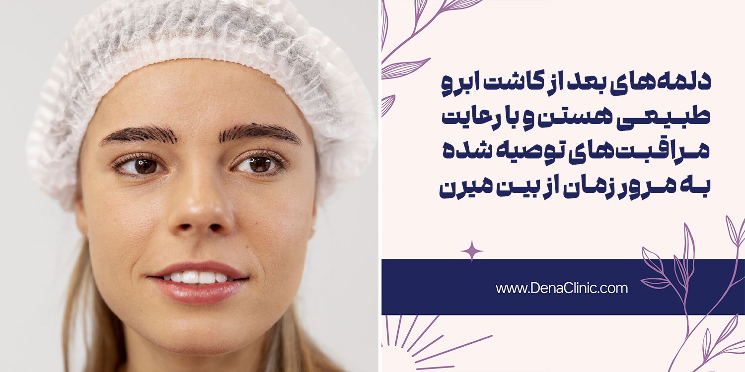 آیا دلمه بعد از کاشت ابرو طبیعی است؟