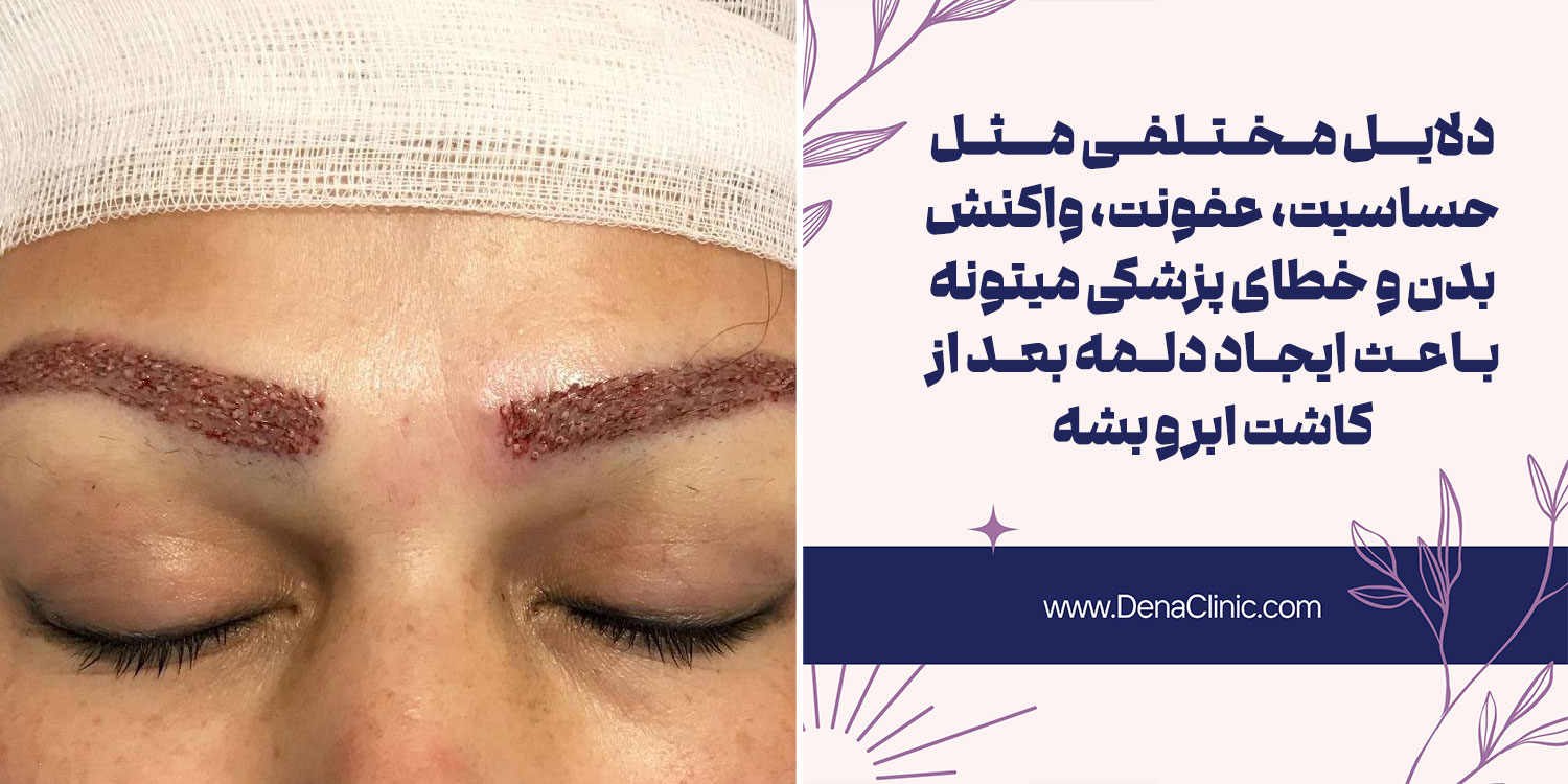 علت تشکیل دلمههای بعد از کاشت ابرو چیست؟