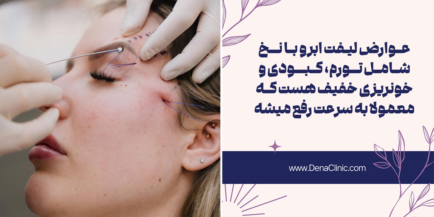 عوارض لیفت ابرو با نخ چیست؟