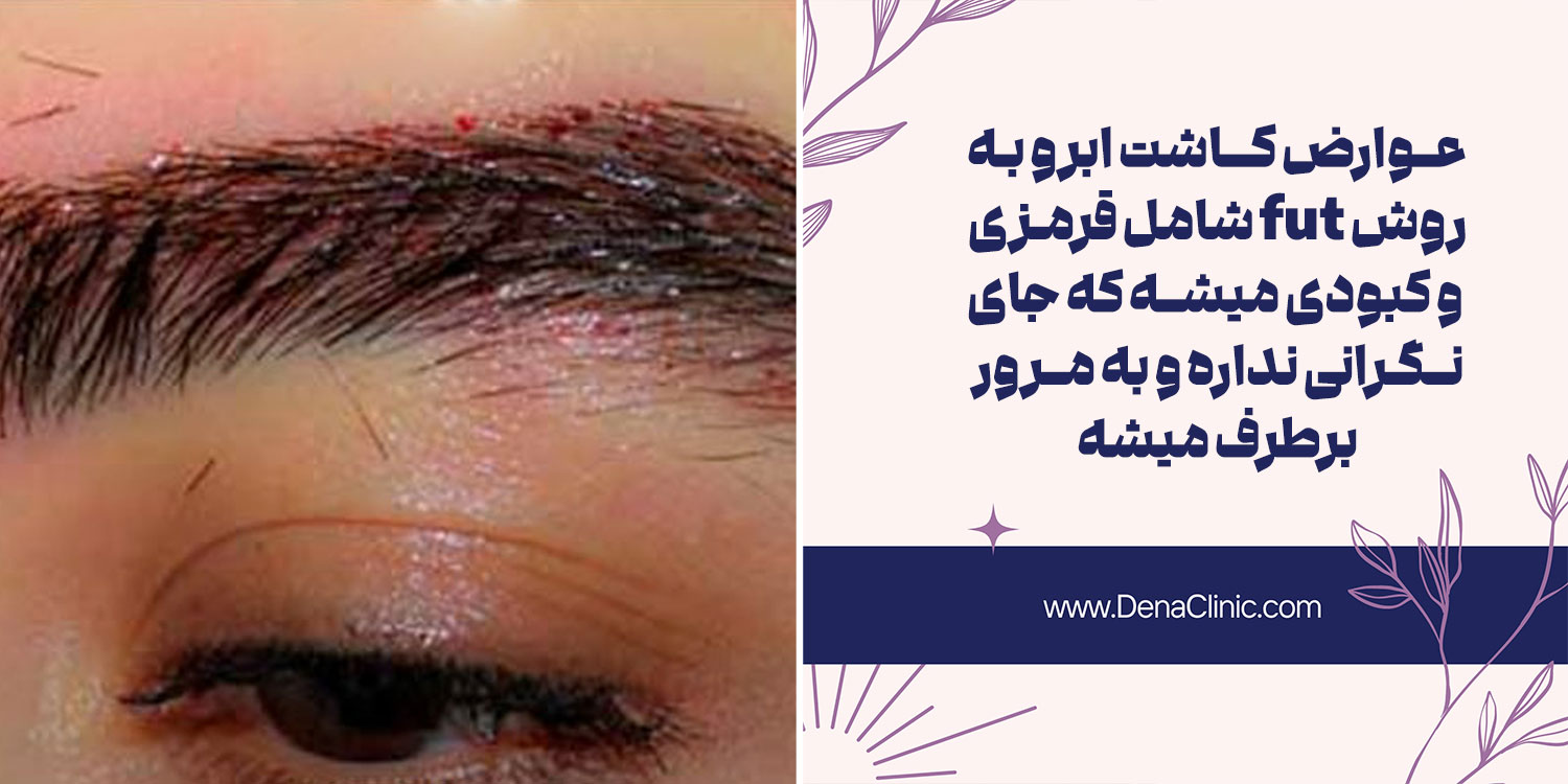 عوارض کاشت ابرو به روش FUT چیست؟