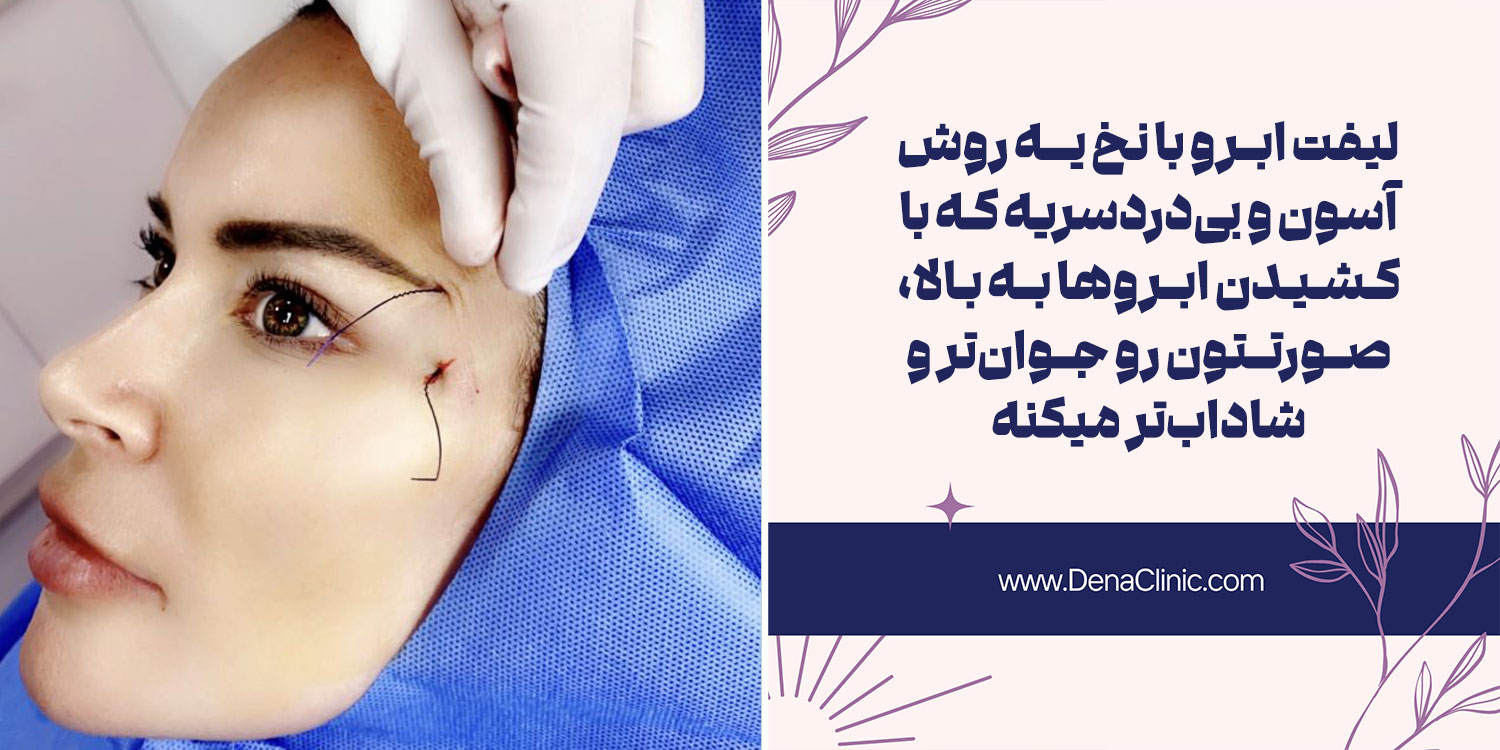 لیفت ابرو با نخ چیست؟