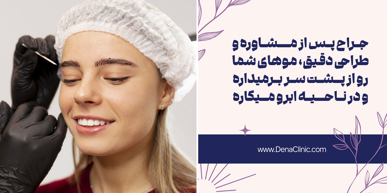 مراحل کاشت ابرو به روش FUT را بدانید!