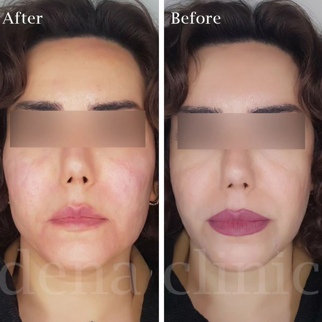نمونه کار تزریق ژل لب 6