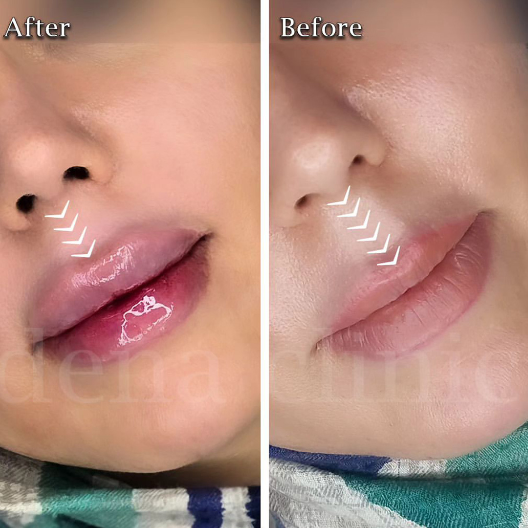 نمونه کار تزریق ژل لب 1