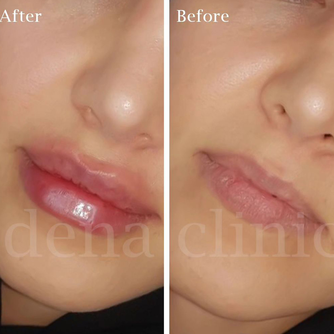نمونه کار تزریق ژل لب 5