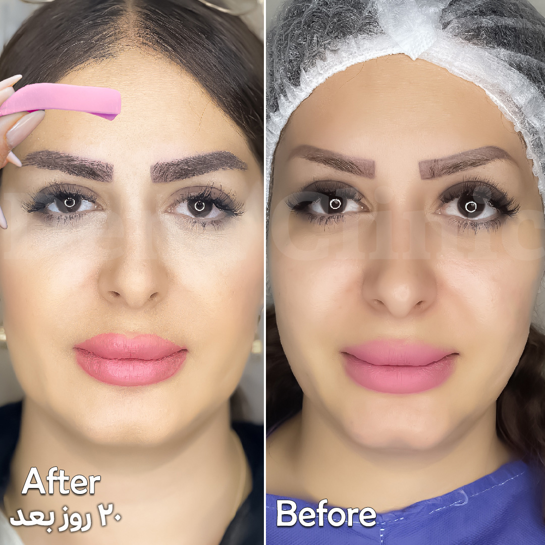 نمونه کار کاشت ابرو در شیراز 2