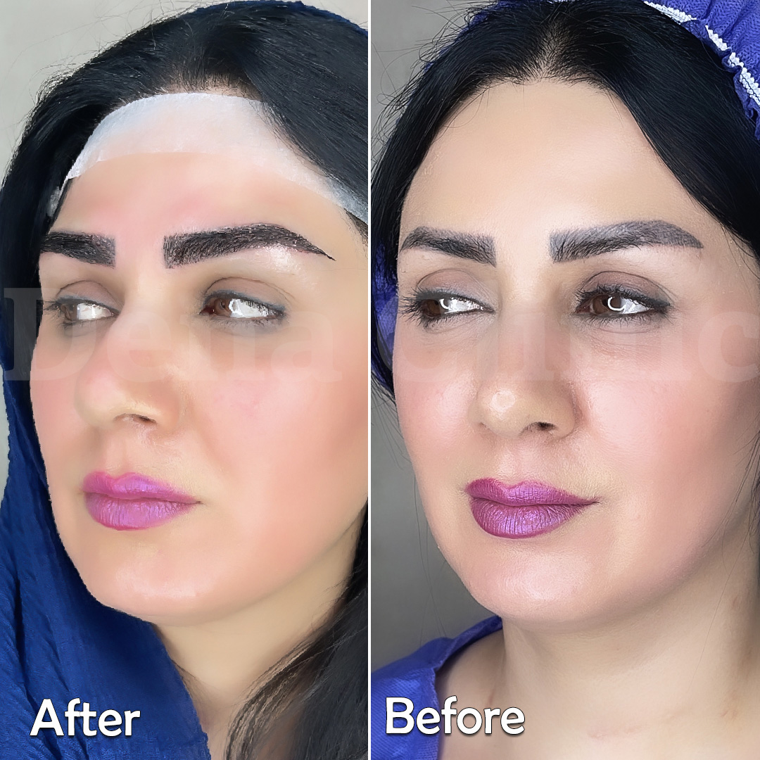 نمونه کار کاشت ابرو در شیراز 3
