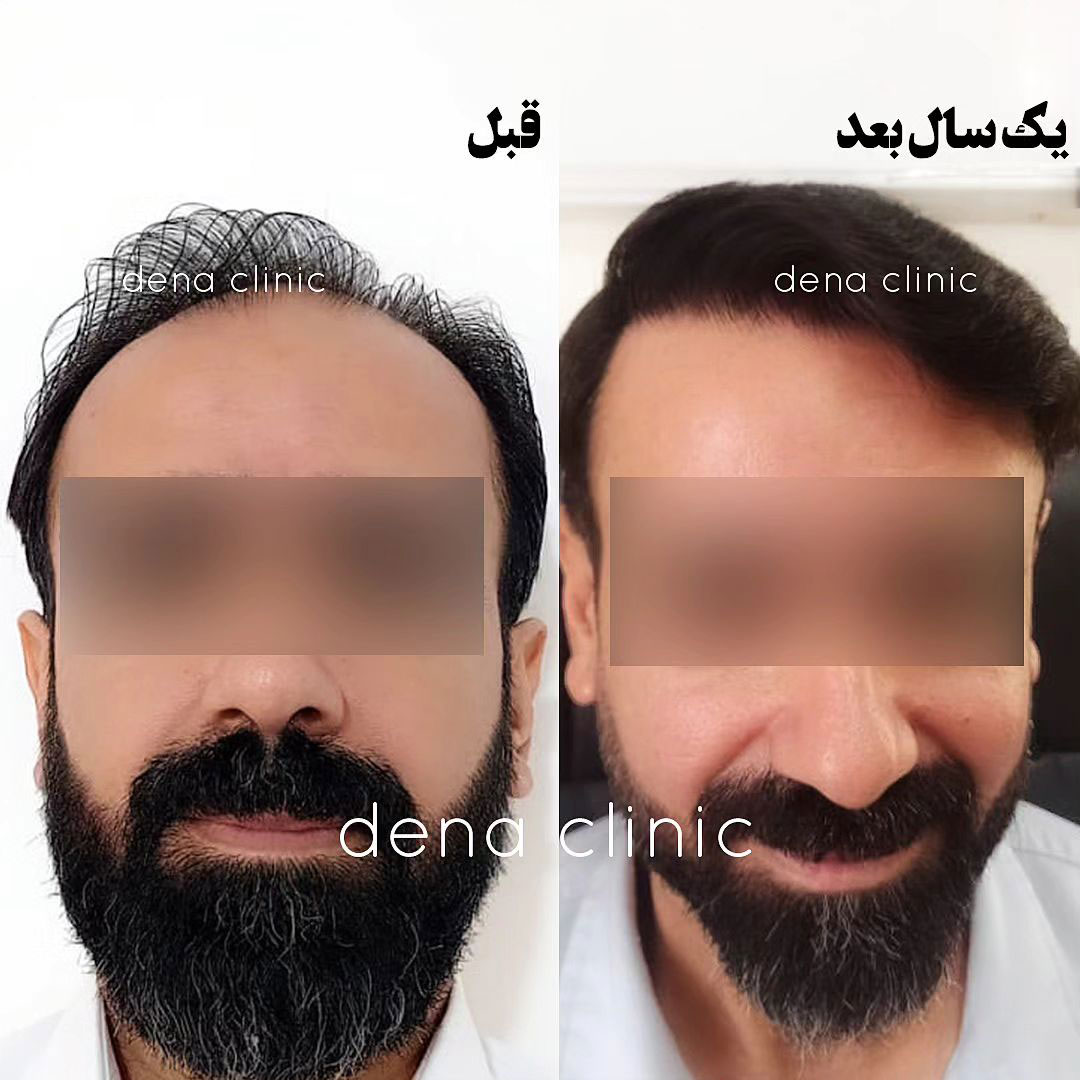 نمونه کار کاشت مو 1