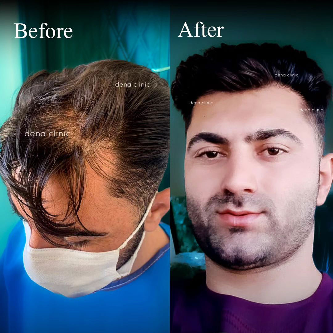 نمونه کار کاشت مو 2