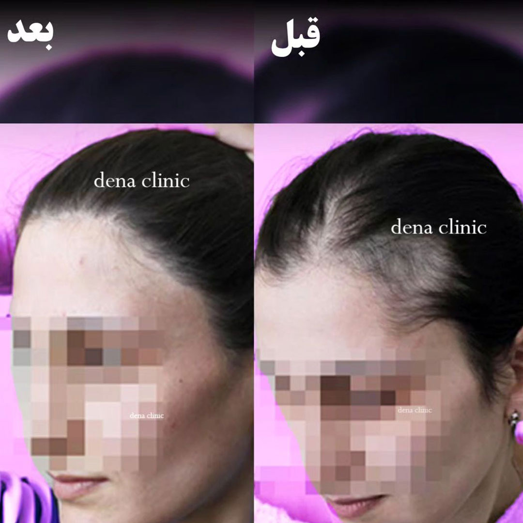 نمونه کار کاشت مو 4