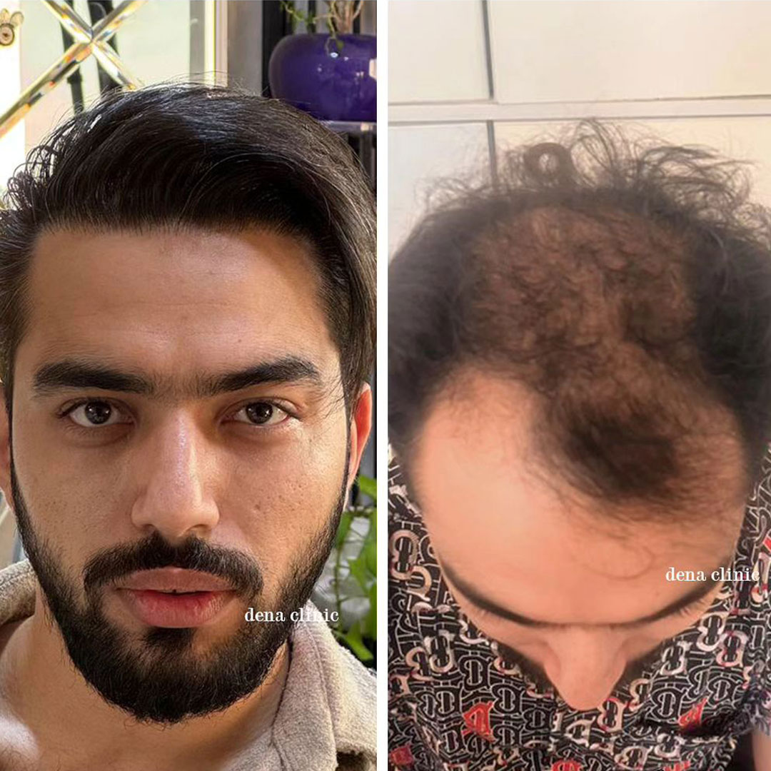 نمونه کار کاشت مو 6
