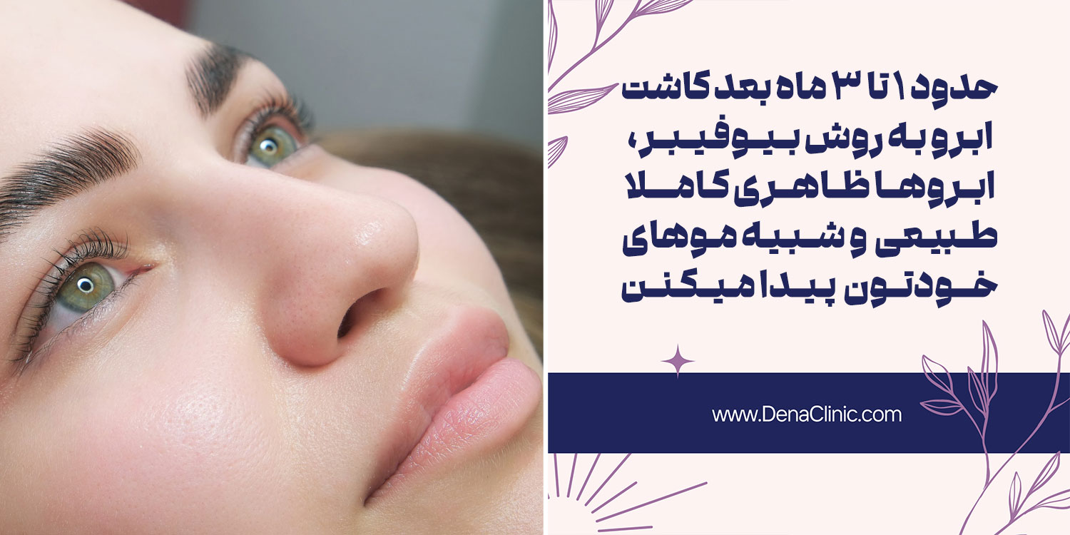چقدر طول میکشد تا نتایج نهایی کاشت ابرو به روش بیوفیبر مشخص شود