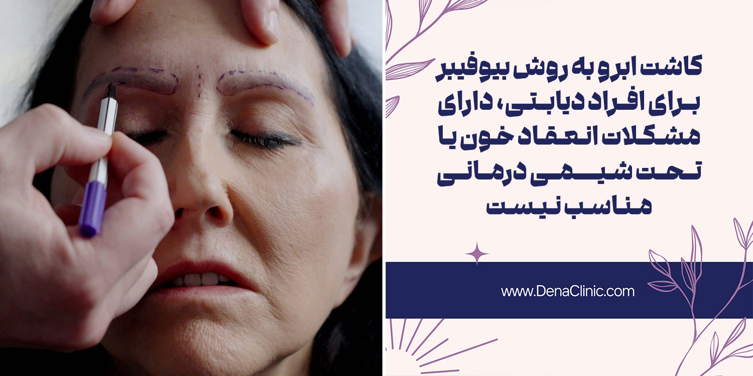 عوارض و خطرات کاشت ابرو به روش بیوفیبر