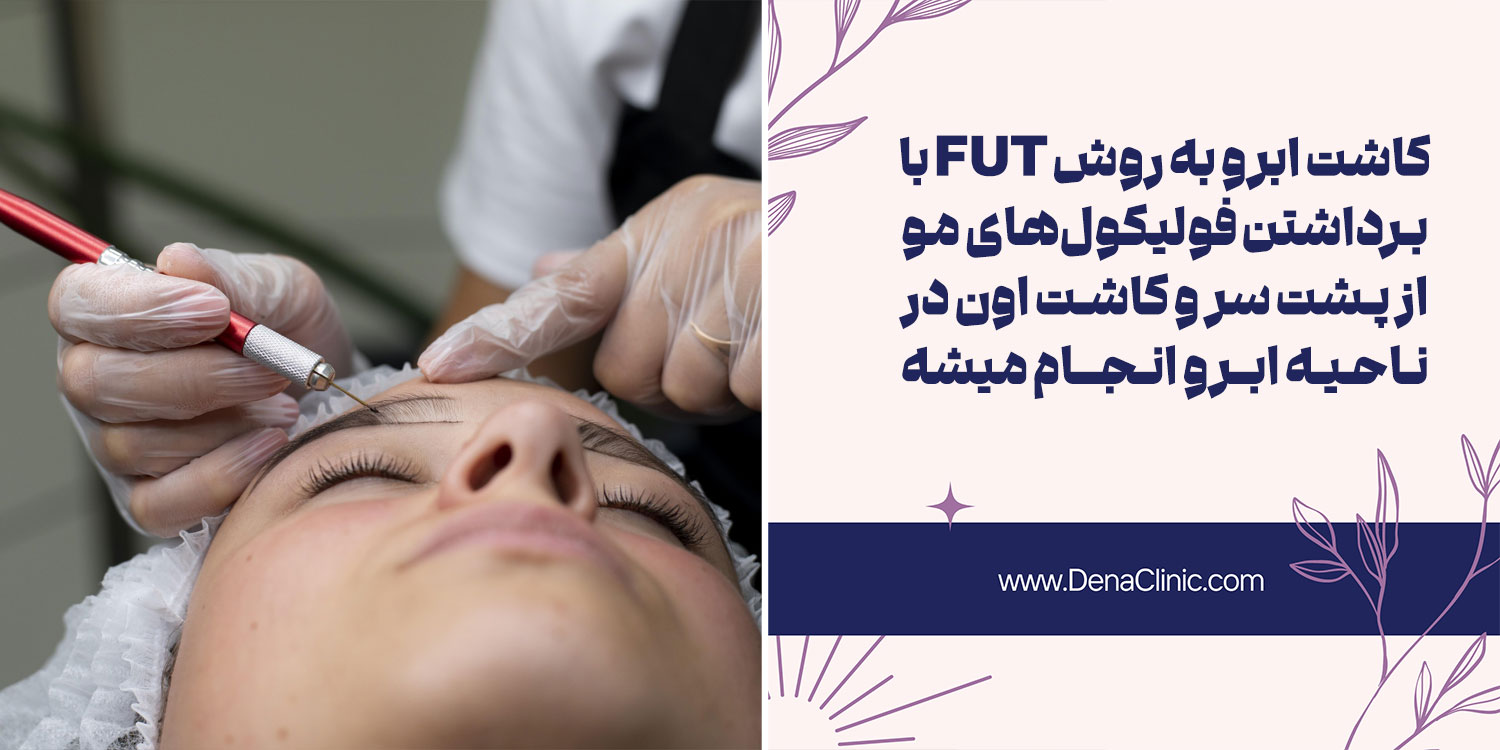 کاشت ابرو به روش FUT چیست؟
