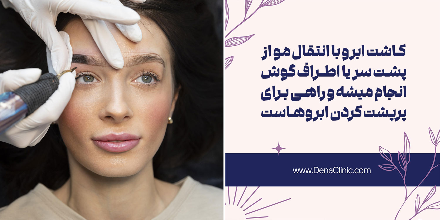 کاشت ابرو همزمان با بلفاروپلاستی چگونه انجام می شود؟