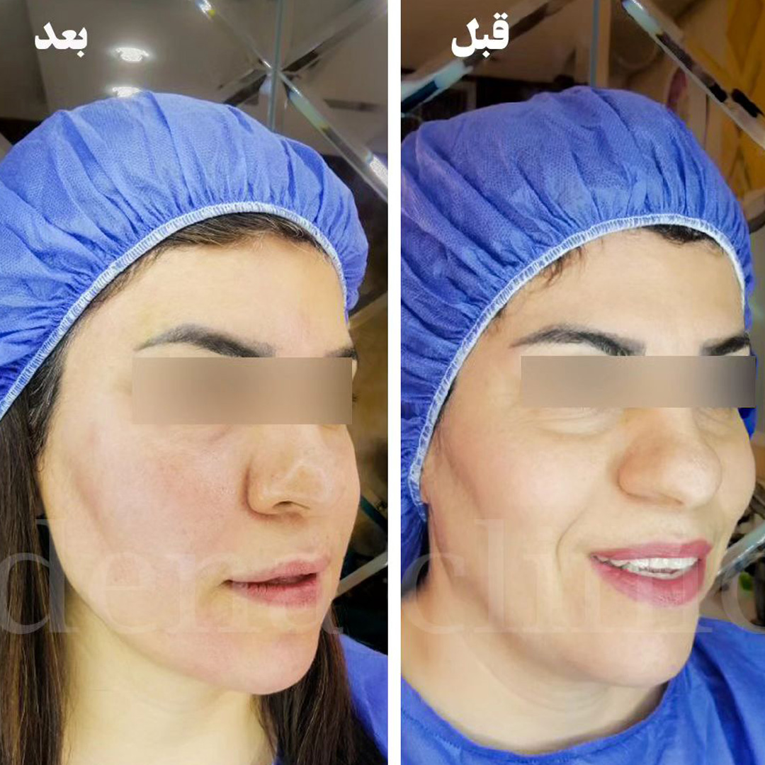 نمونه کارهای کانتورینگ صورت 3