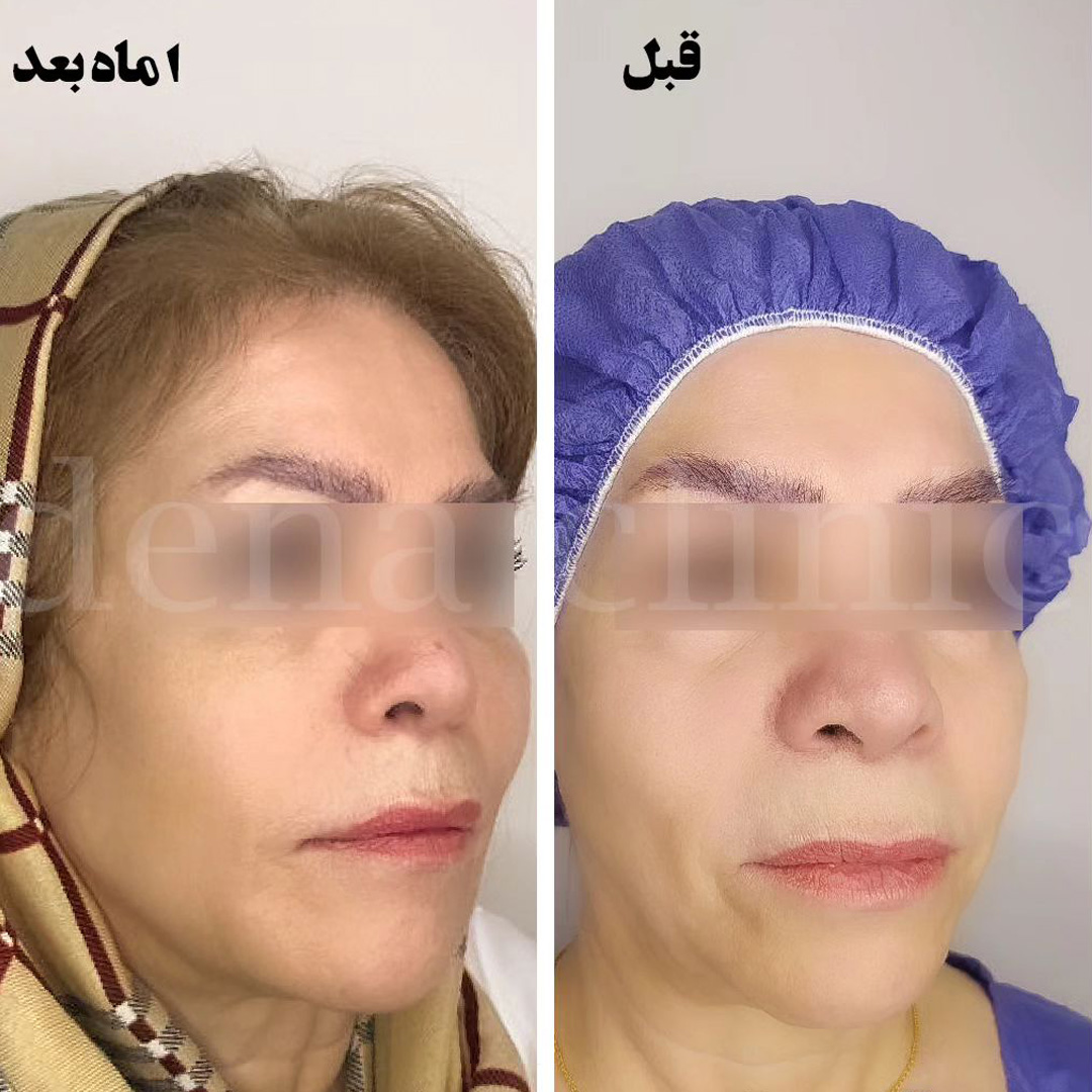 نمونه کارهای کانتورینگ صورت 4