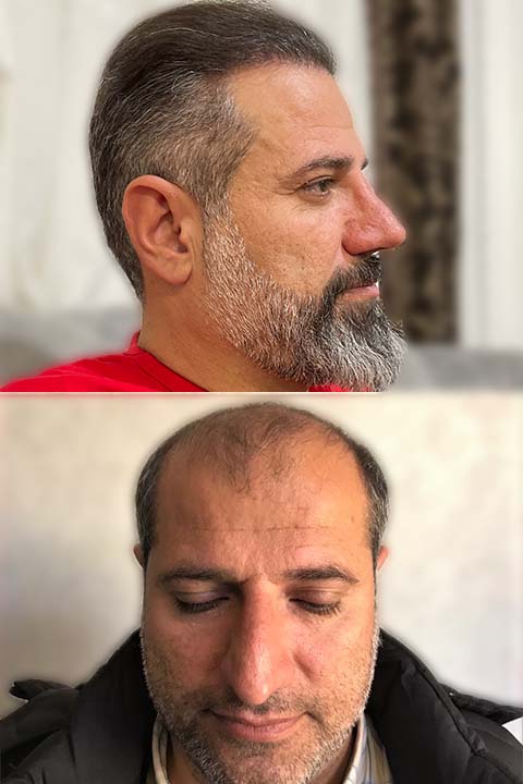 کاشت مو